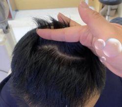 -大麦微针植发丨全国连锁