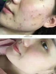 点击看大图 -悟空祛痘·专业祛痘机构