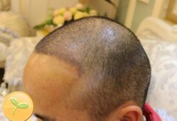 -大麦微针植发丨全国连锁