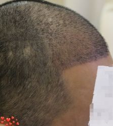 -大麦微针植发丨全国连锁