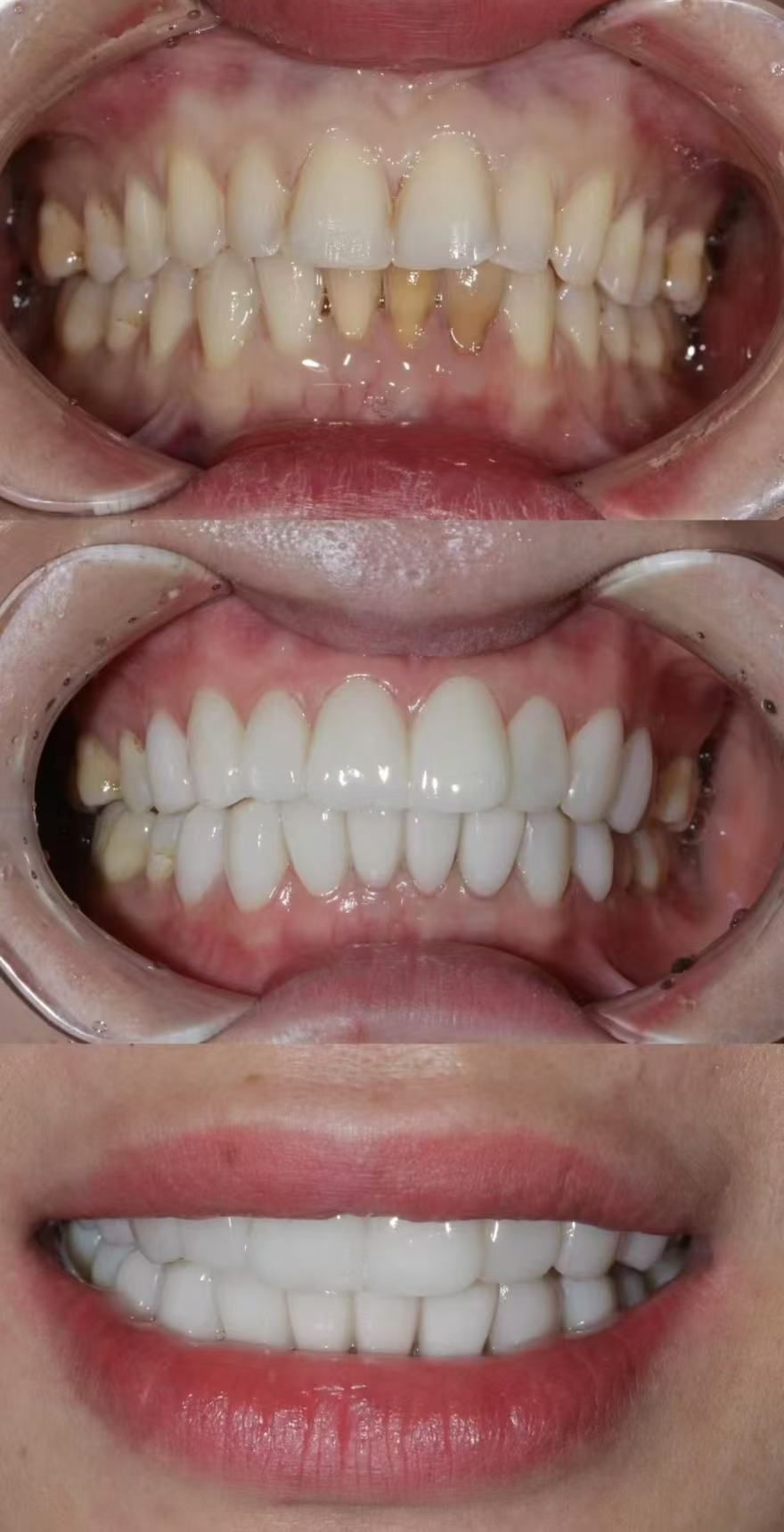 牙贴面不仅可以改变牙齿形态,让牙齿变得光滑好看,还可以让牙齿变白好