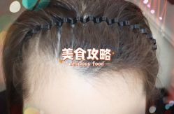 -大麦微针植发全国连锁