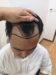 点击看大图 -大麦微针植发丨全国连锁