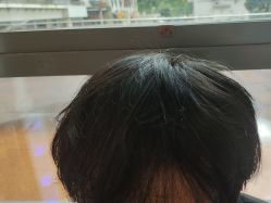 -碧莲盛·不剃发植发