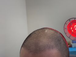 -大麦微针植发全国连锁