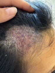 -碧莲盛·不剃发植发