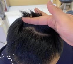 -大麦微针植发丨全国连锁