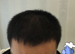 -大麦微针植发丨全国连锁