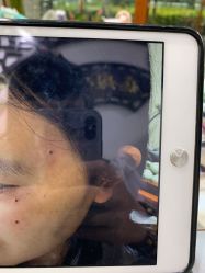 -痣斑堂·取大痣