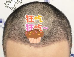 -大麦微针植发全国连锁