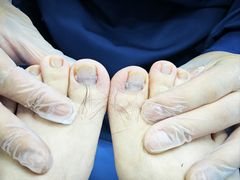 -Andrew指甲专科灰指甲·甲沟炎矫正·3D步态矫形鞋垫定制(浦三路店)