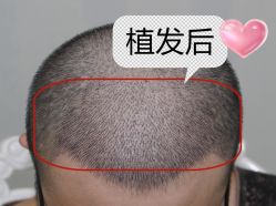-大麦微针植发丨全国连锁