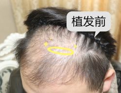 -大麦微针植发全国连锁