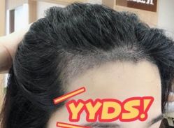 -大麦微针植发丨全国连锁