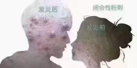 -瑶芳清颜草本祛痘