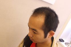 -大麦微针植发丨全国连锁