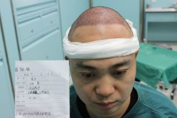 点击看大图 -大麦微针植发丨全国连锁