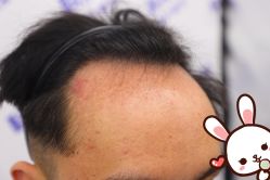 点击看大图 -大麦微针植发丨全国连锁