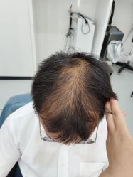 -大麦微针植发全国连锁