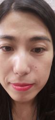 -北京美痣堂古方祛痣斑疣瘊