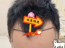 -大麦微针植发全国连锁