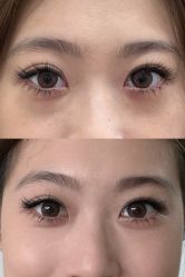 -广州健丽·去眼袋医疗美容机构