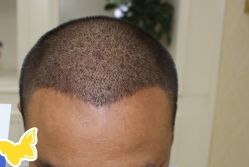 -大麦微针植发丨全国连锁