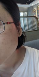 体验前-深圳春天阳光医院·轮廓抗衰中心