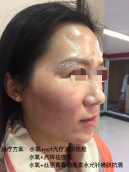 脸部抗衰-光SPA科技美肤