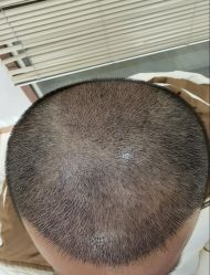 -大麦微针植发丨全国连锁