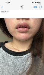 体验后-佛山艺美医疗美容·整形·美肤·塑形