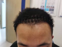 -大麦微针植发全国连锁