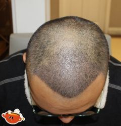 -大麦微针植发丨全国连锁