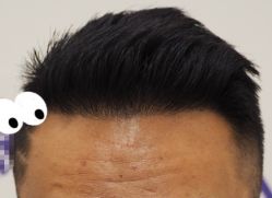 -大麦微针植发全国连锁