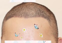 -大麦微针植发全国连锁