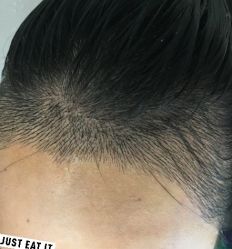 -大麦微针植发丨全国连锁