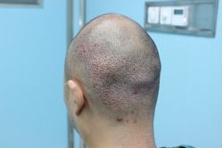 点击看大图 -大麦微针植发丨全国连锁