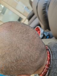 -碧莲盛·不剃发植发