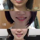 骨性深覆合金属自锁矫正案例 