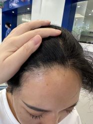 -大麦微针植发全国连锁