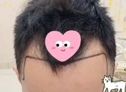 -大麦微针植发全国连锁