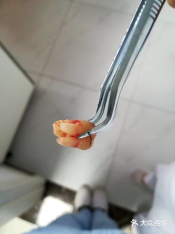 智齿总是发炎勇敢和它说拜拜