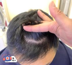 -大麦微针植发丨全国连锁
