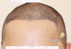 -大麦微针植发全国连锁