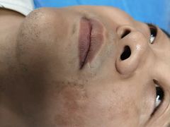 -杭州仁易堂中医康复医院疤痕修复