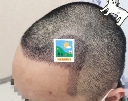 -大麦微针植发全国连锁