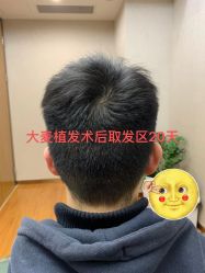 -大麦微针植发全国连锁