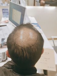 -碧莲盛·不剃发植发