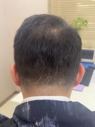 -大麦微针植发丨全国连锁