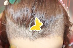 -大麦微针植发全国连锁